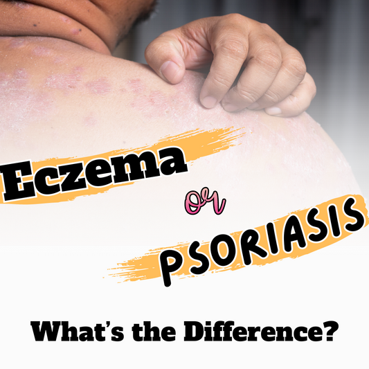 What's the Difference between Eczema and Psoriasis?