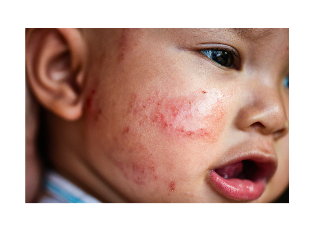 Tips for Managing Eczema in Children