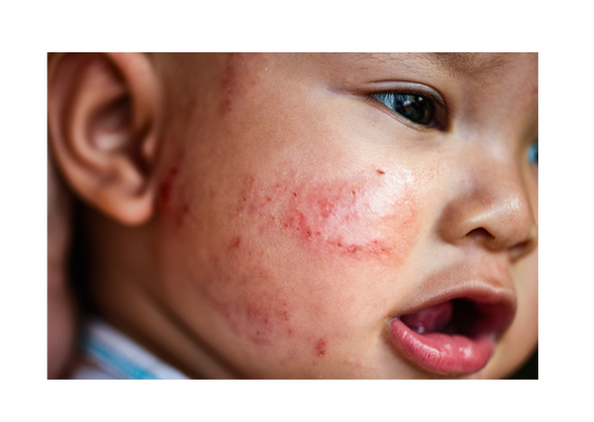 Tips for Managing Eczema in Children