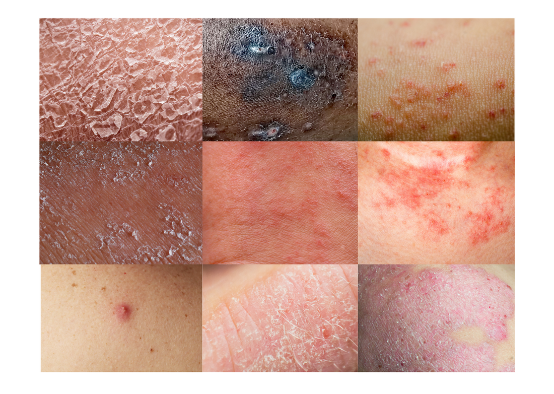 Types of eczema deals