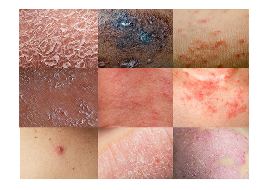 Different Types of Eczema