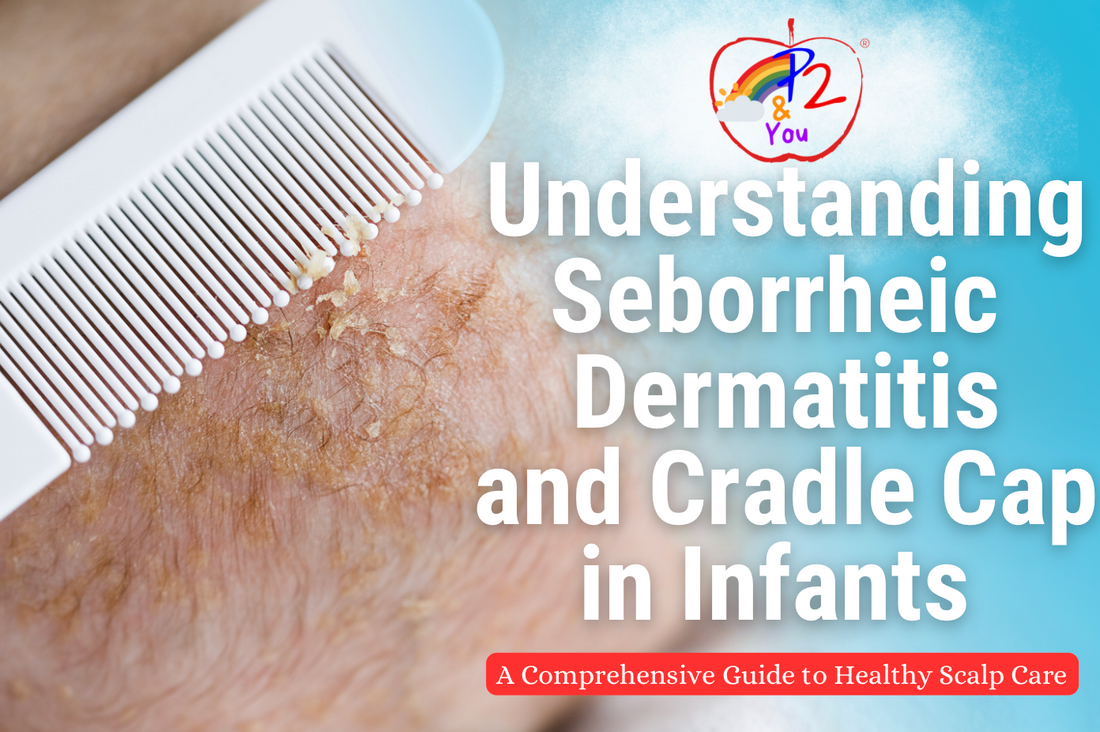Understanding Seborrheic Dermatitis and Cradle Cap in Infants